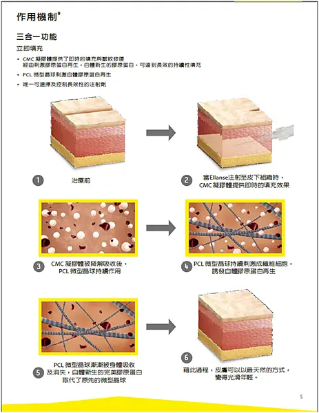 台北洢蓮絲Ellanse推薦|腋下,私密處雷射除毛,台北醫美