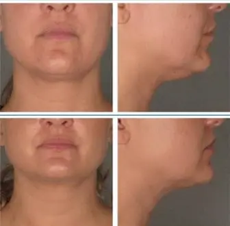 溶脂針4 溶脂針推薦4