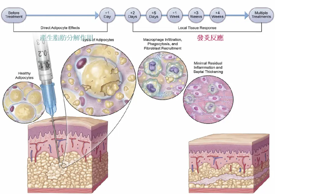 溶脂針6 溶脂針推薦6